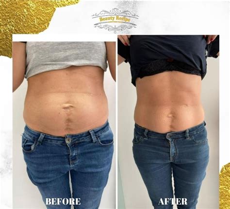 ems weight loss results|Before & after results and pictures of Electrical Muscle Stimulation .